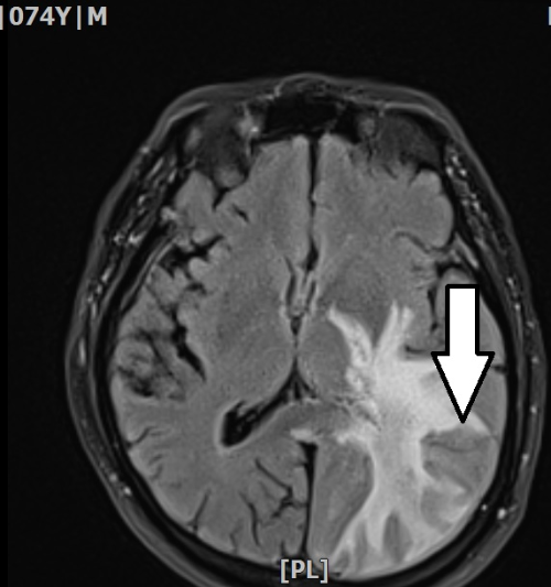 中枢神经系统淋巴瘤（CNS lymphoma）。