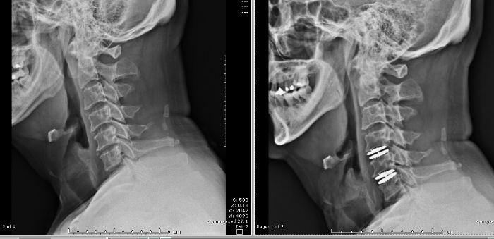 人工颈椎间盘置换术（手术前及手术后）。